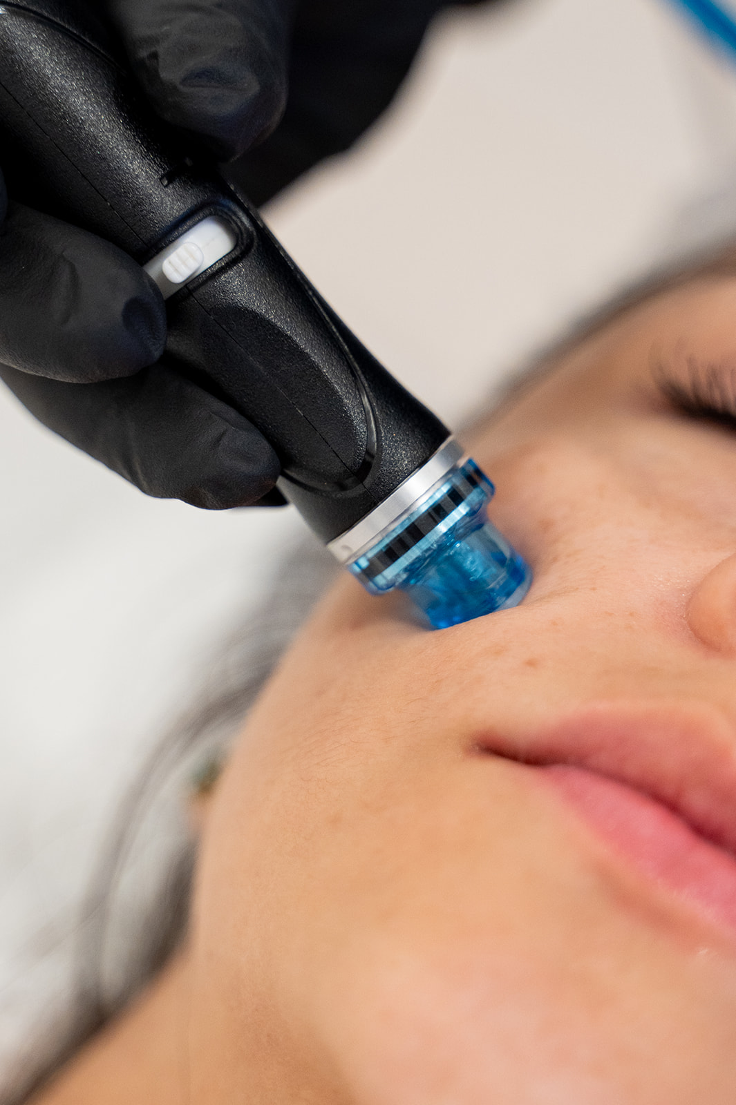 Hydrafacial